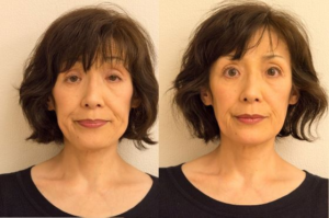 60代女性小顔矯正Before-After