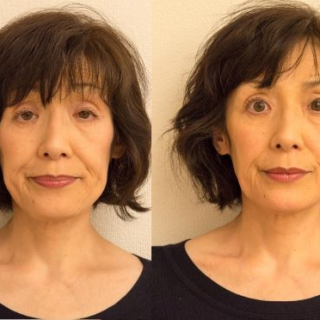 60代女性小顔矯正Before-After